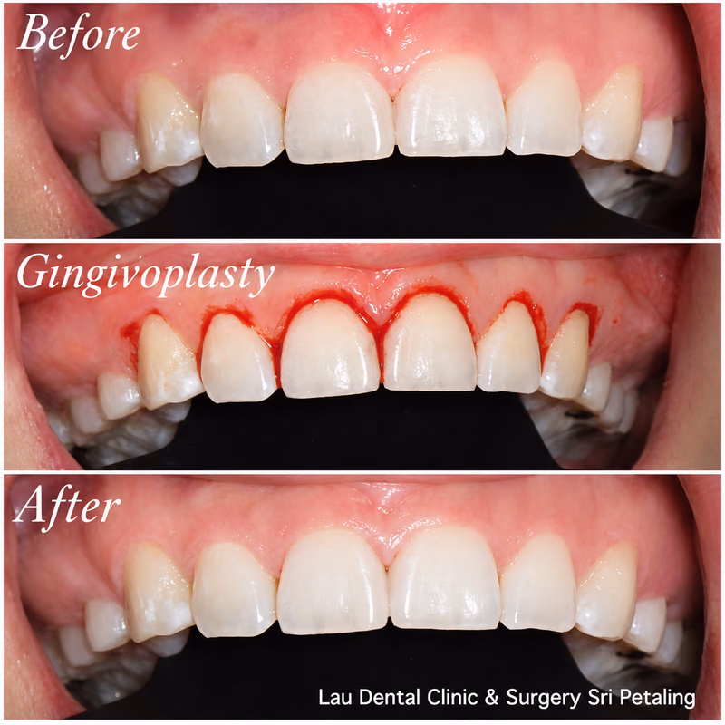 Gingivoplasty gum reshaping treatment creating a more even gumline and balanced front tooth appearance.