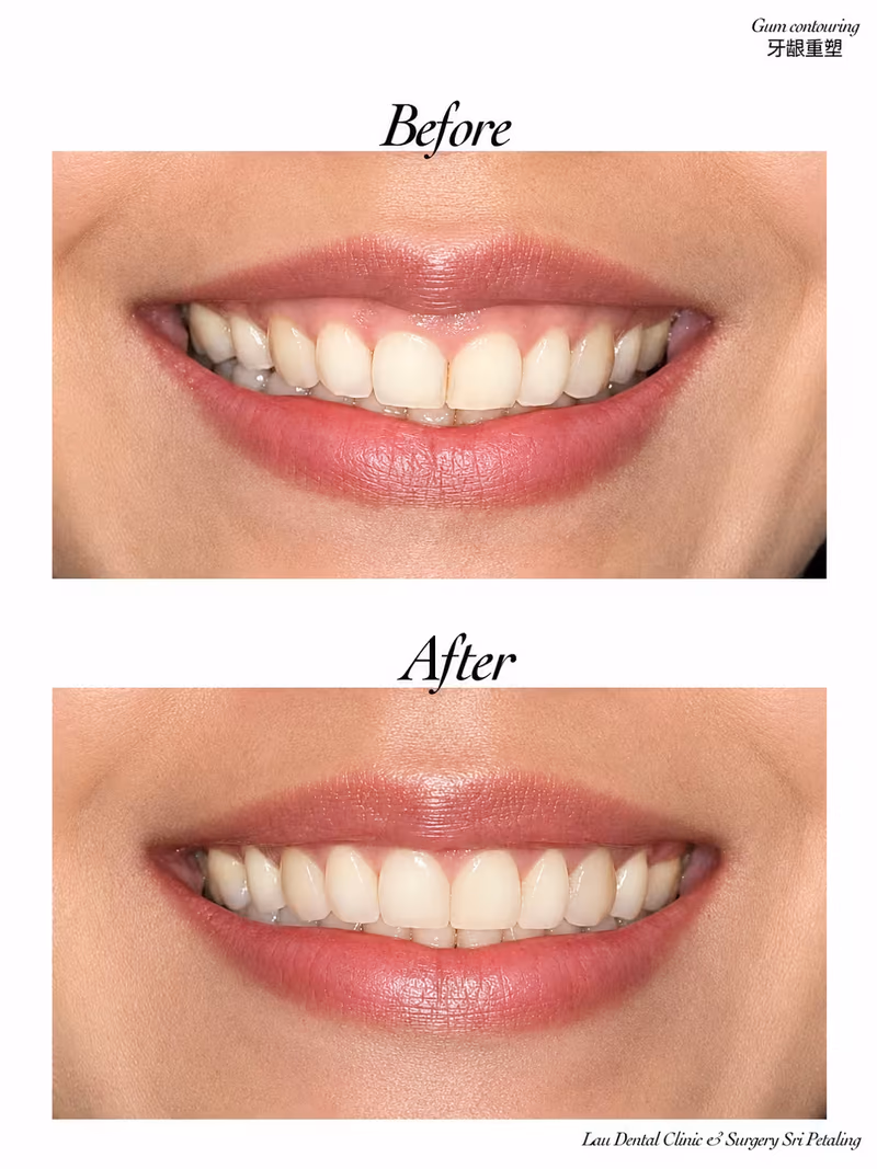 Before and after gum contouring treatment creating a more balanced and aesthetically pleasing smile.