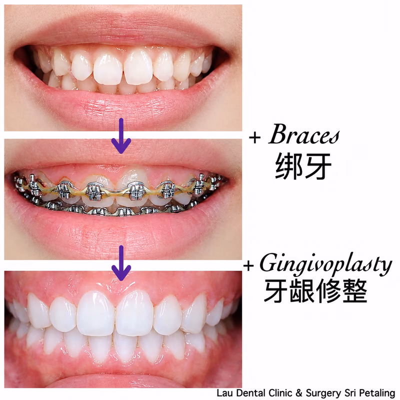 Combined braces and gingivoplasty treatment correcting a gummy smile for a more balanced, natural smile line.