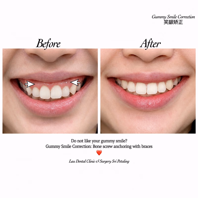 Gummy smile correction using bone screw anchoring with braces, reducing excess gum display when smiling.