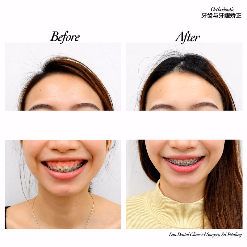 Before and after braces treatment improving gummy smile and smile alignment.