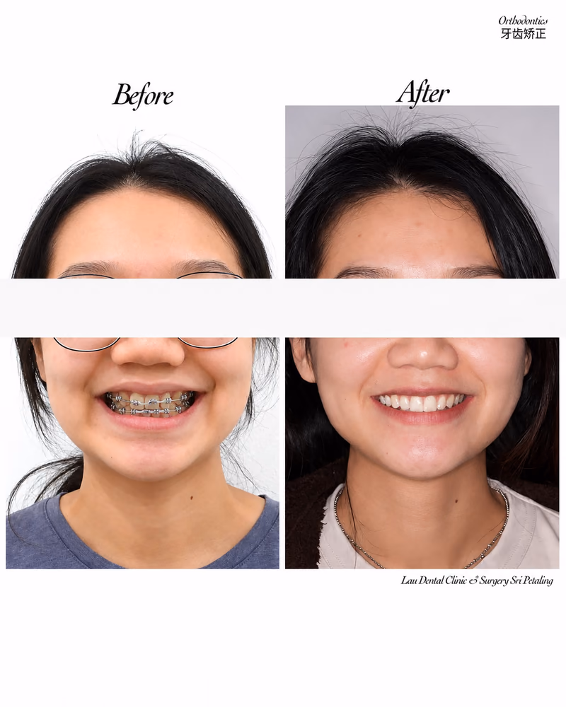 Before and after braces treatment improving teeth alignment and smile confidence.
