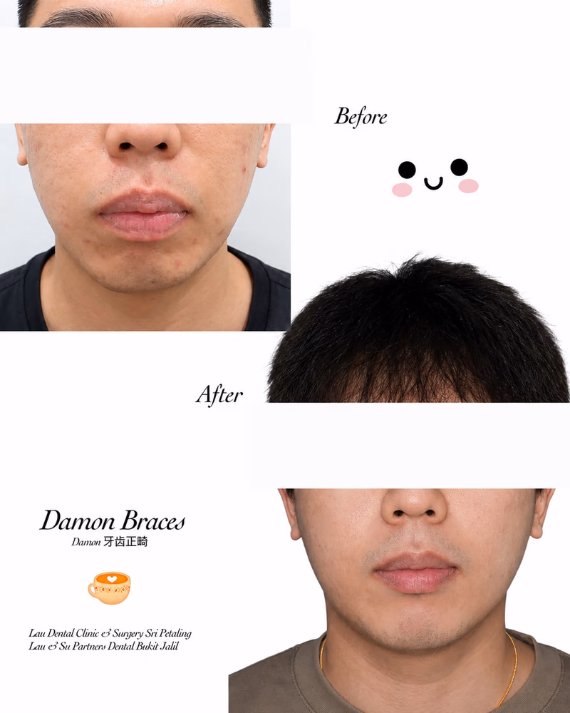 Damon braces before and after treatment improving facial symmetry and smile balance.