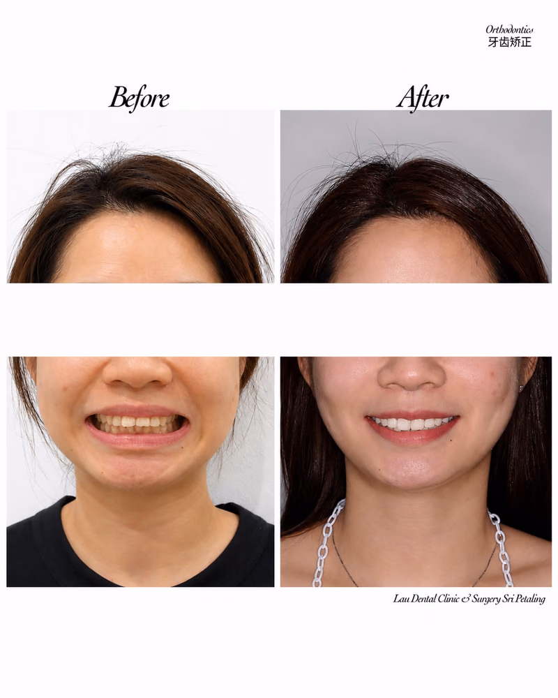 Before and after orthodontic treatment improving smile alignment and facial balance.