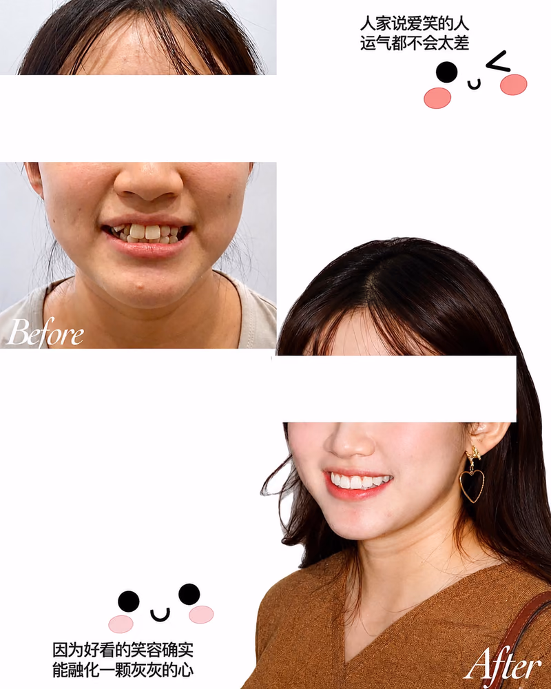 Before and after orthodontic treatment improving crooked teeth and smile aesthetics.