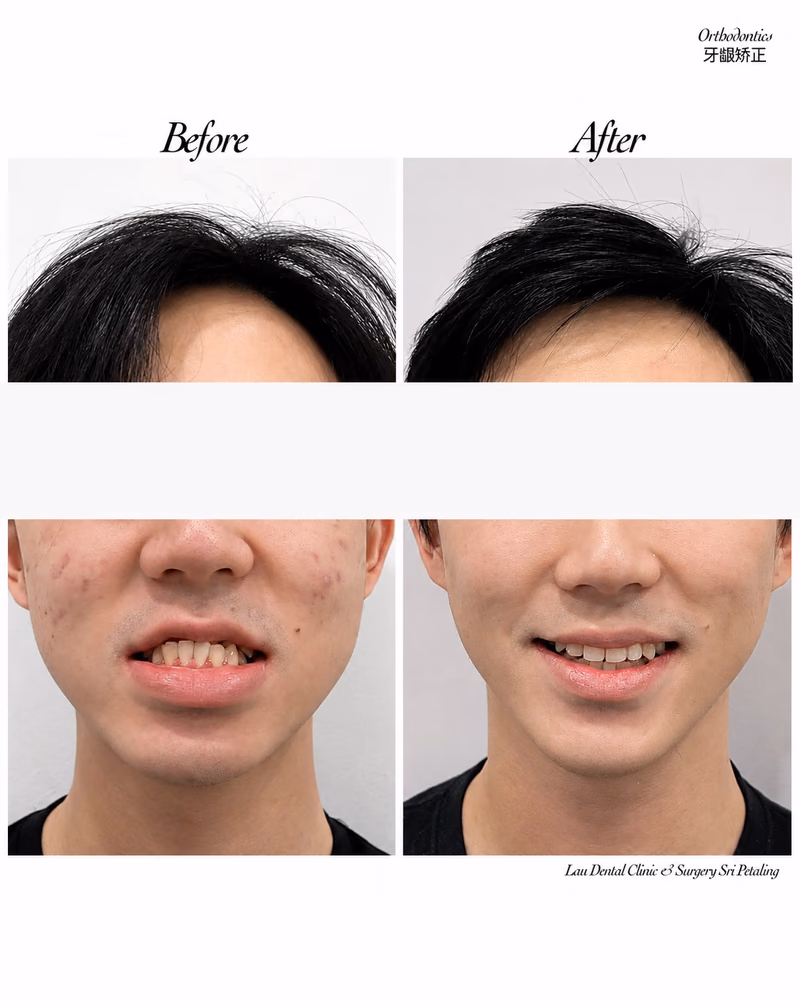 Before and after orthodontic treatment correcting crooked teeth and improving smile confidence.