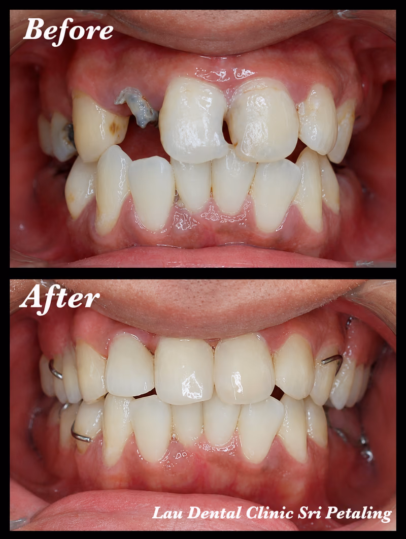 Full arch dental crown and bridge treatment restoring multiple broken teeth for improved dental function and a balanced smile.