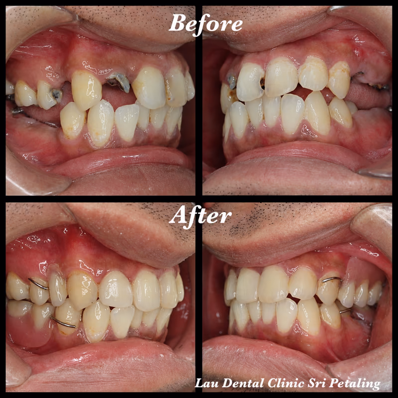Side view of dental crown and partial denture restoration replacing missing teeth and rebuilding bite function.