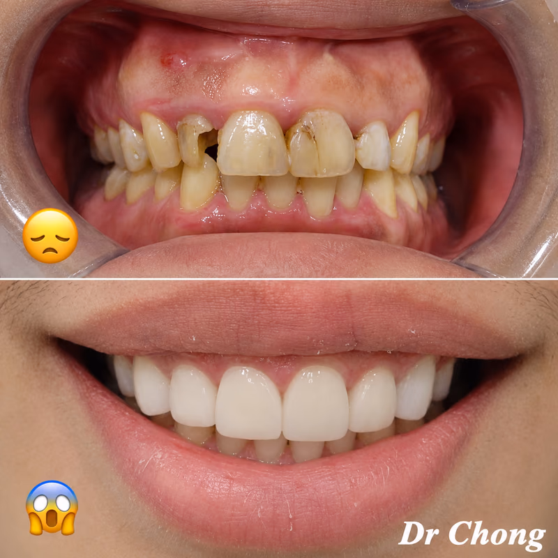 Dental crown smile makeover restoring severely decayed front teeth into a bright, natural-looking smile.