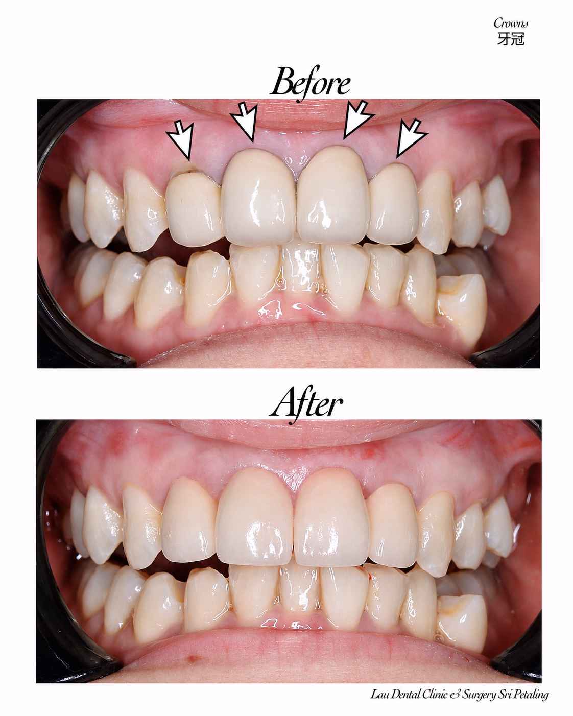 Before and after dental crown treatment restoring damaged front teeth for a natural and balanced smile.