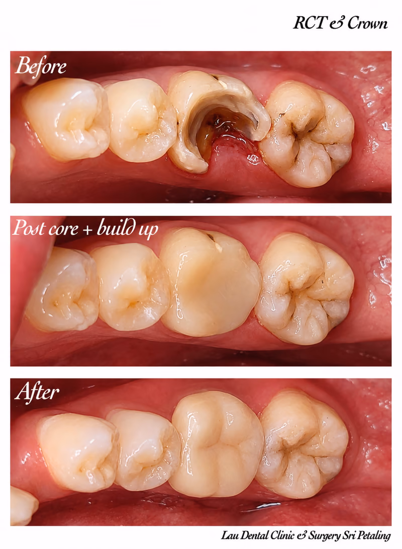 Root canal treatment with core build-up and dental crown restoring a fractured molar for long-lasting function.