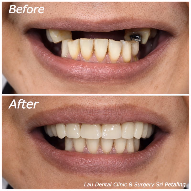 Dental implant treatment replacing multiple missing front teeth for an enhanced, more confident smile.