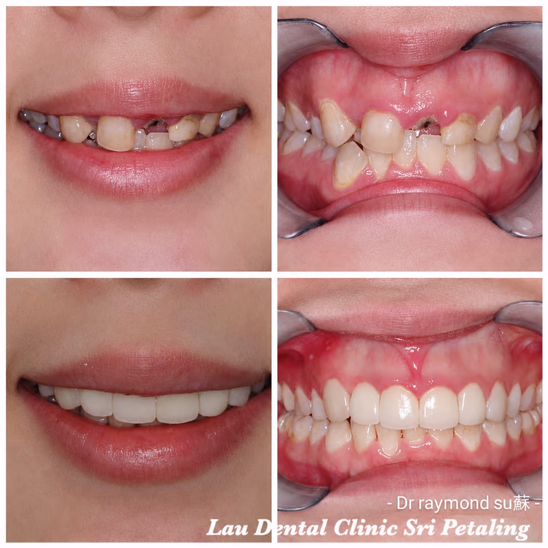 Dental implant treatment replacing multiple missing front teeth, shown with full smile and intraoral views.