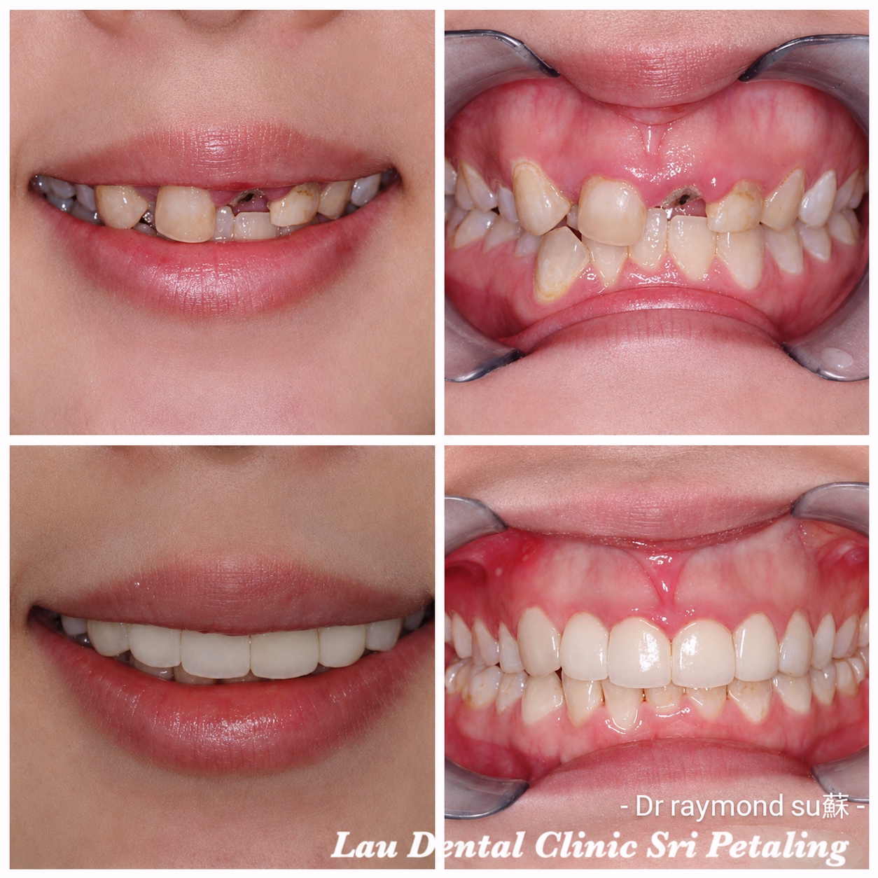 Dental implant treatment replacing multiple missing front teeth, shown with full smile and intraoral views.