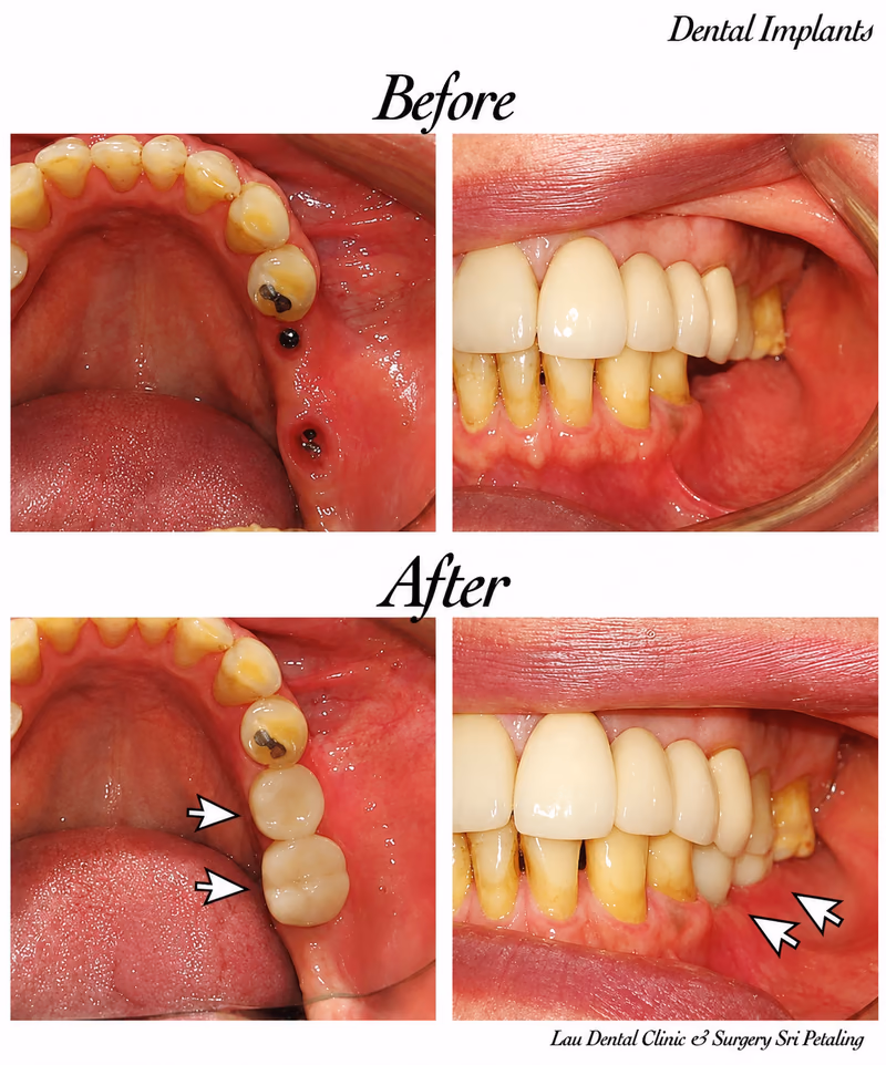 Side view of dental implant treatment replacing multiple missing back teeth, restoring bite alignment.
