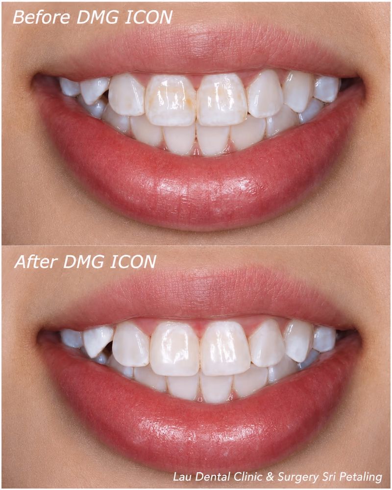DMG ICON infiltration treatment reducing brown and white spot discoloration on the front teeth for a brighter smile.