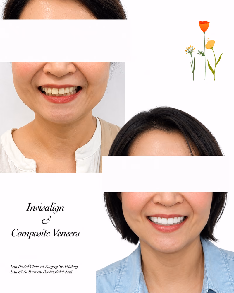 Invisalign and composite veneers before and after treatment creating a straighter, brighter smile.