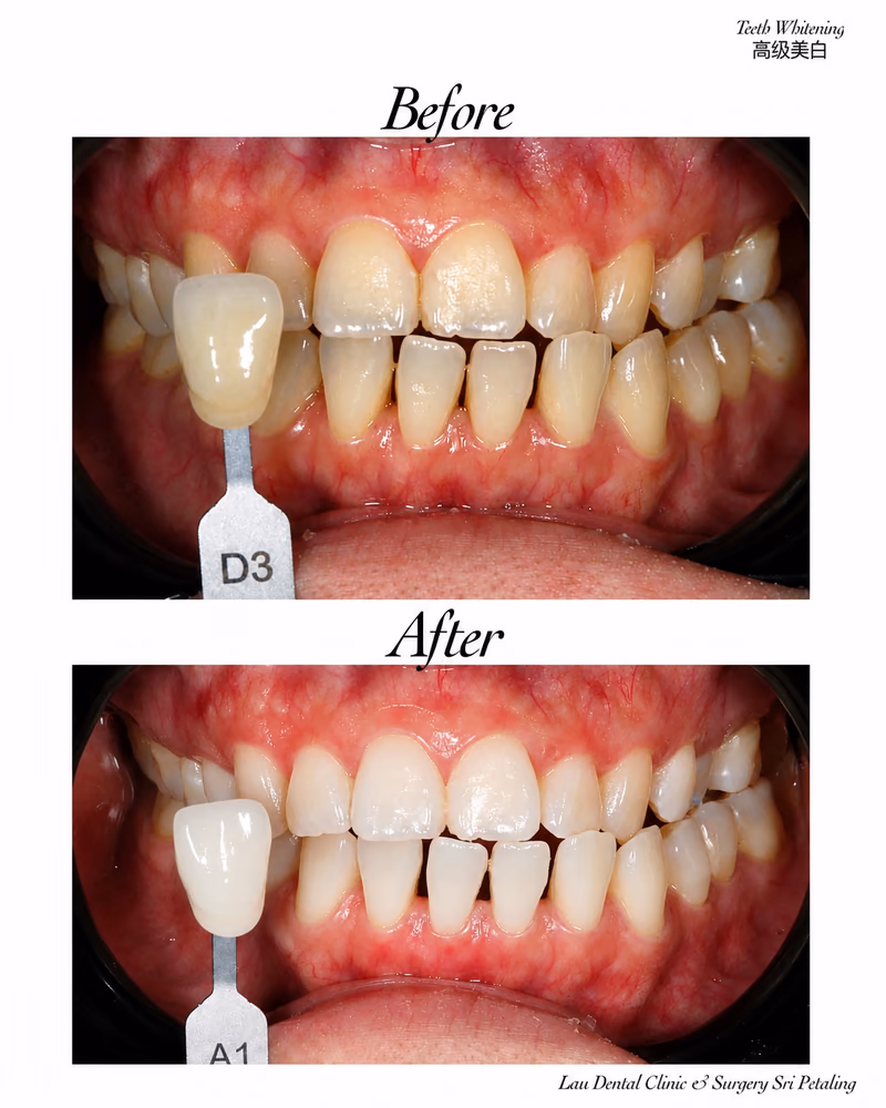 Premium teeth whitening treatment improving tooth shade from D3 to A1, restoring a bright, even smile.