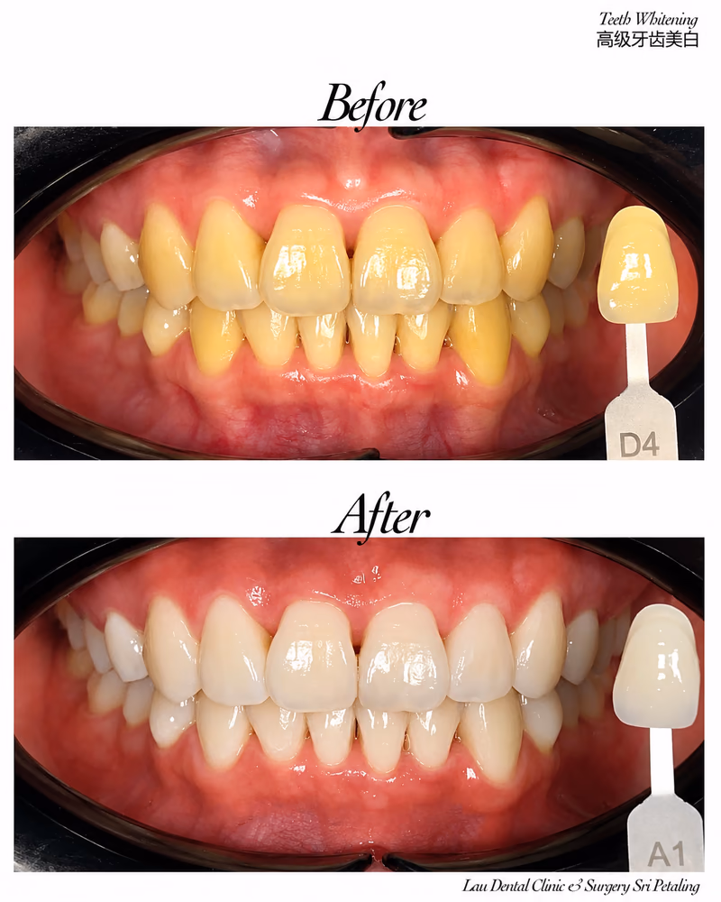 Before and after teeth whitening treatment improving tooth shade from D4 to A1.