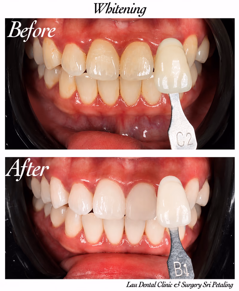 Teeth whitening treatment improving tooth shade from C2 to B1 for an enhanced, more confident smile.