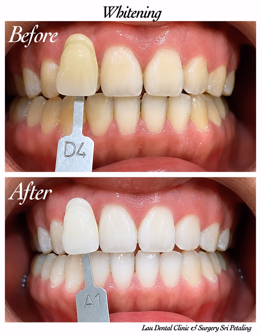 Teeth whitening treatment improving front tooth shade from D4 to A1 for a noticeably brighter smile.