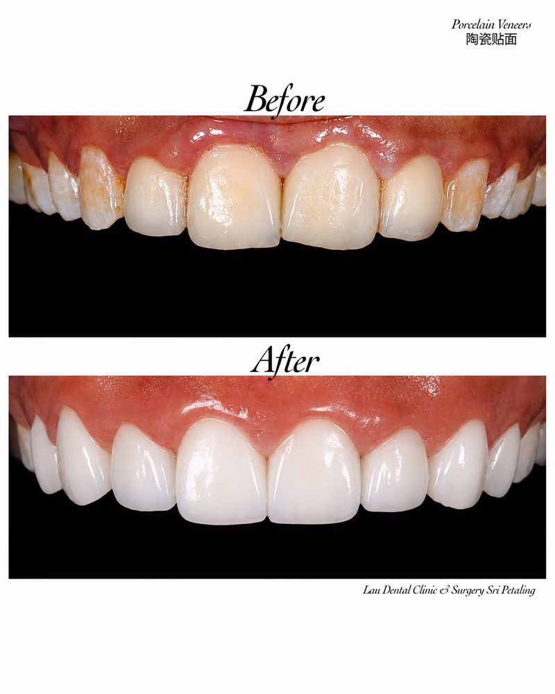 Porcelain veneers before and after treatment improving tooth color, shape, and smile aesthetics.