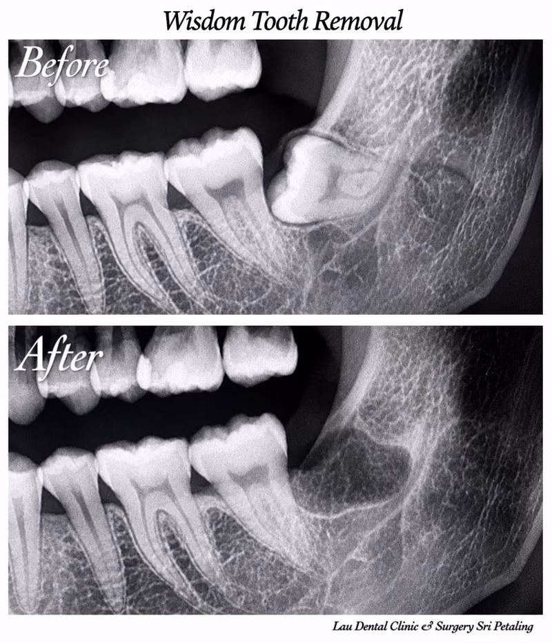X-ray comparison showing an impacted wisdom tooth before removal and complete bone healing afterward.
