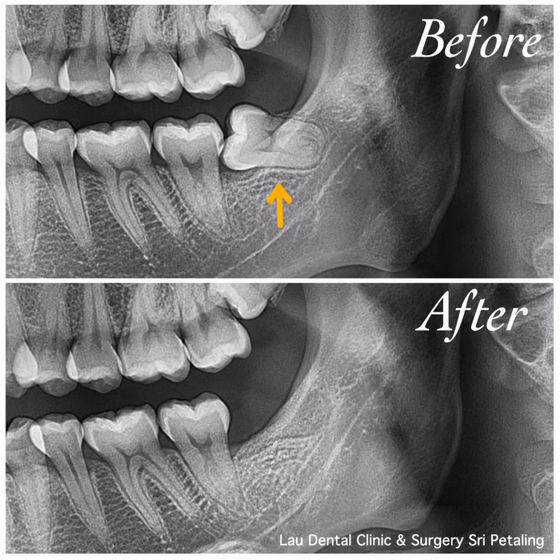 X-ray comparison of an impacted wisdom tooth before extraction and healthy bone healing afterward over time.