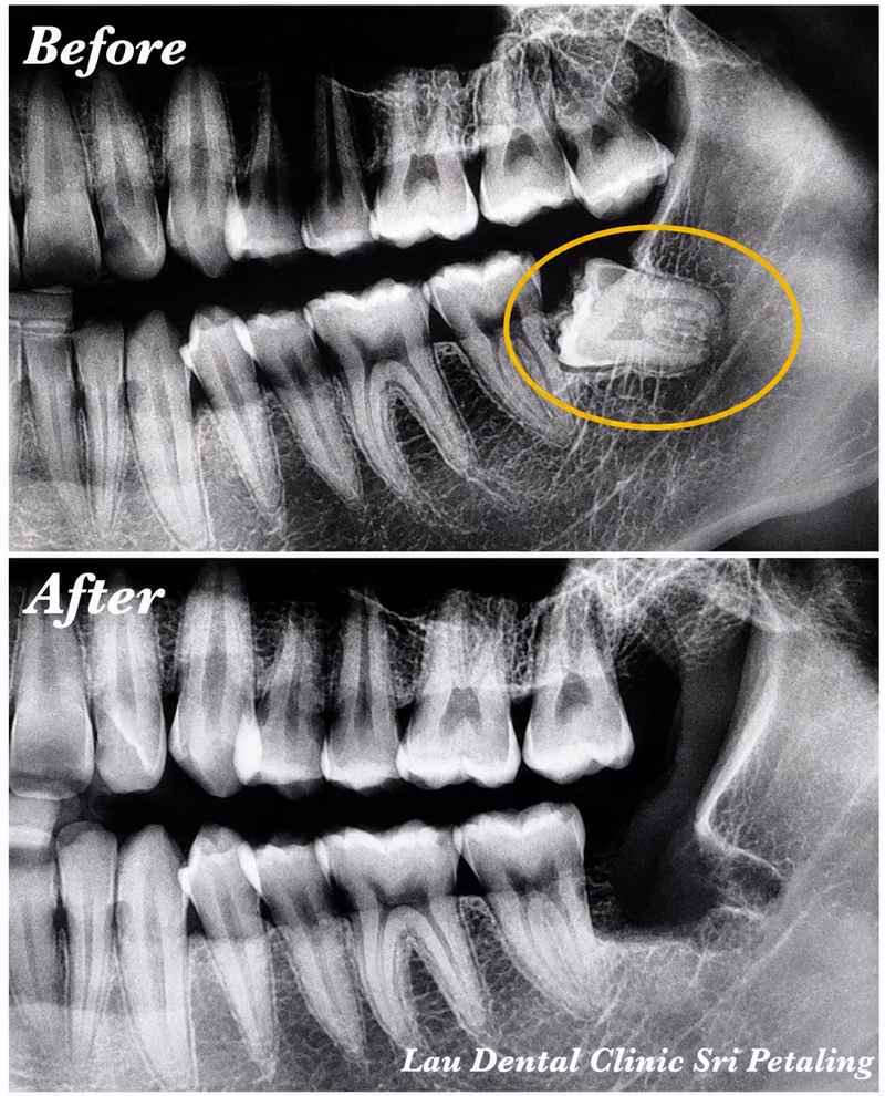 X-ray comparison showing an impacted wisdom tooth in the jaw before extraction and clean healing after.