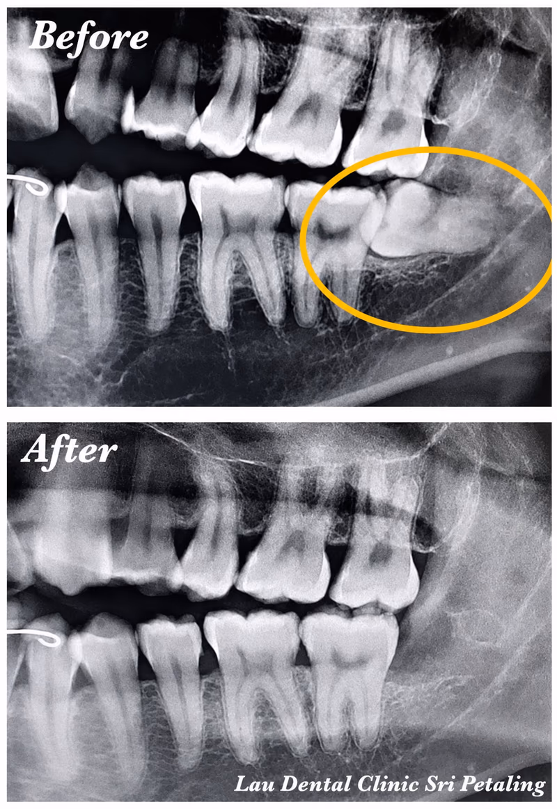 X-ray showing an impacted wisdom tooth before extraction and clean, healthy bone healing afterward over time.