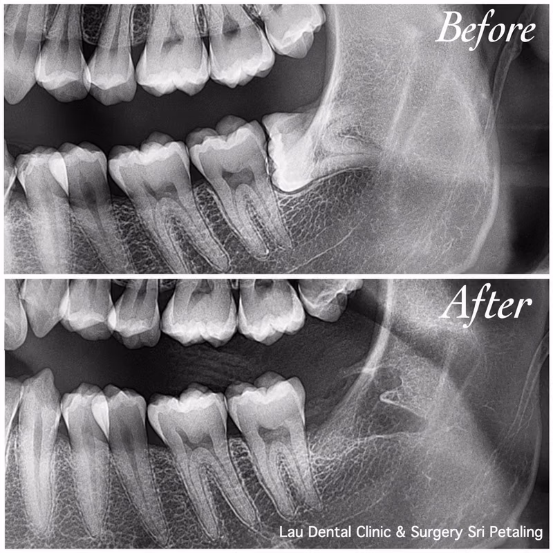 X-ray comparison showing an impacted wisdom molar before extraction and clean bone healing afterward.