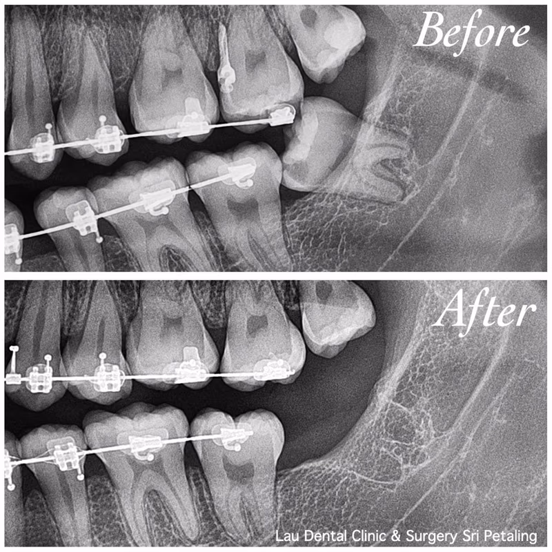 X-ray comparison of wisdom tooth extraction performed during braces treatment, showing healthy healing.
