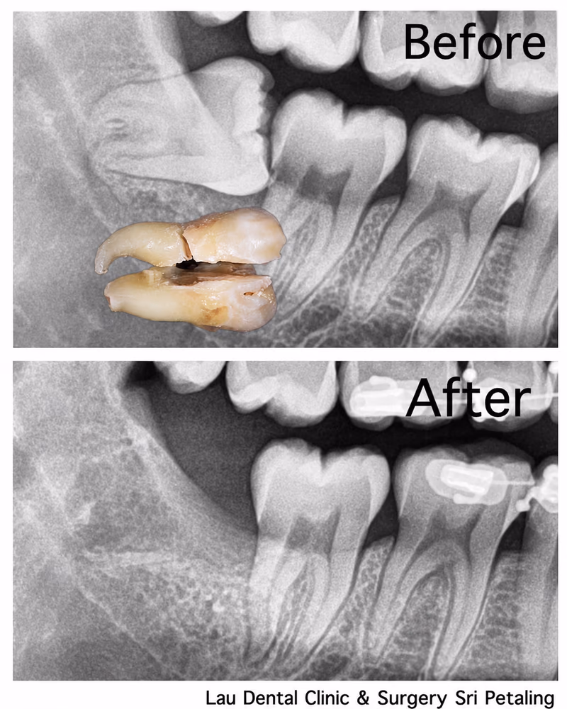 X-ray showing a wisdom tooth with a broken root before extraction and clean, complete healing after treatment.