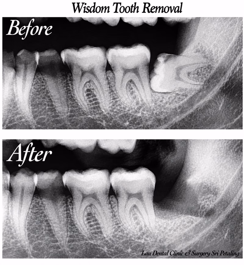 X-ray comparison showing wisdom tooth extraction near a back molar with healthy bone healing afterward.