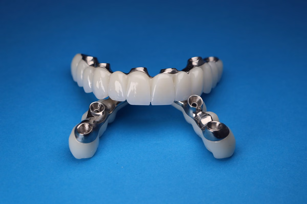 A full-arch dental prosthesis mounted on four titanium abutments, showing how one fixed bridge is carried by four implants.