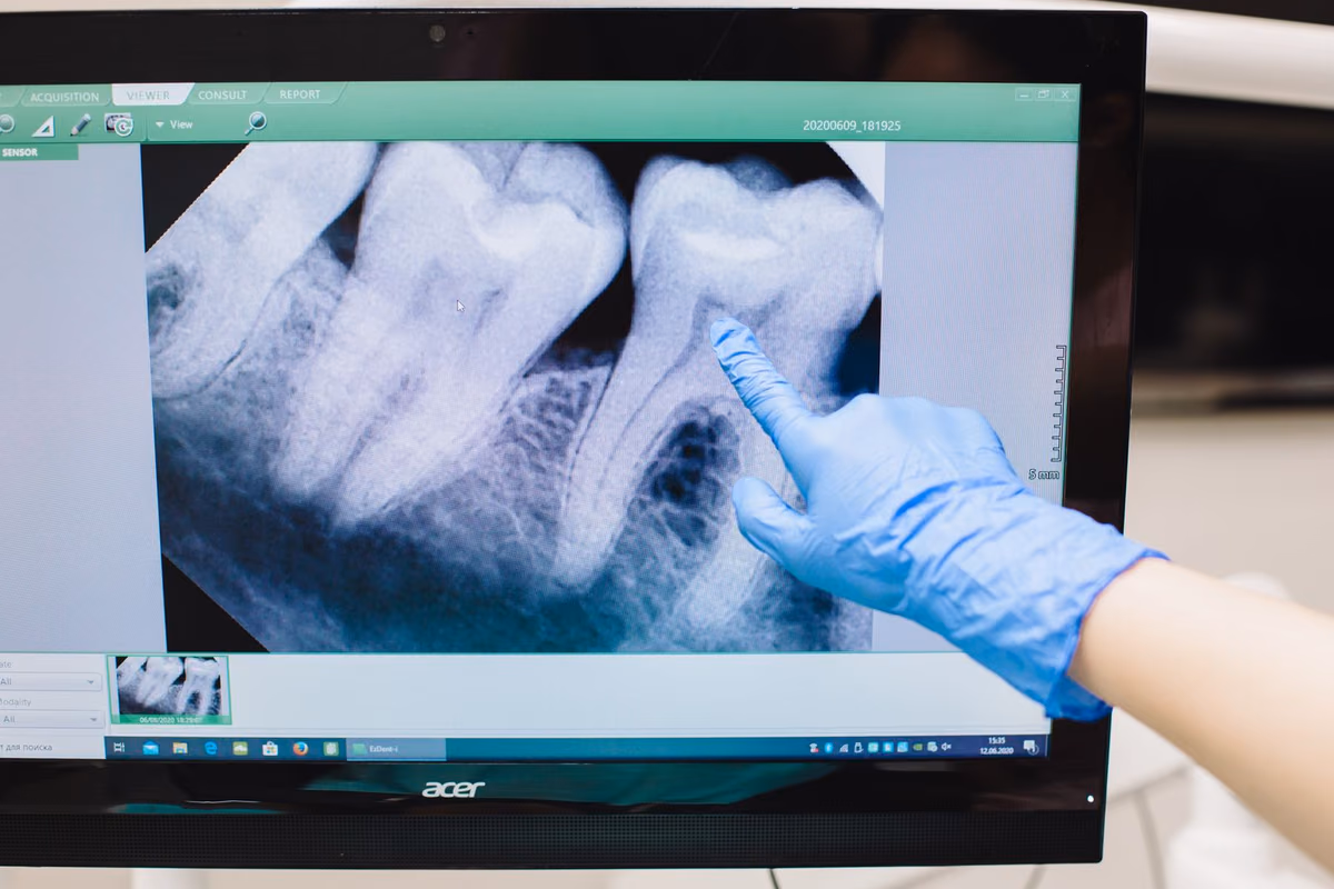 A gloved finger pointing to a tooth root on a dental X-ray displayed on a clinic monitor, the scan that determines whether bone grafting is needed.
