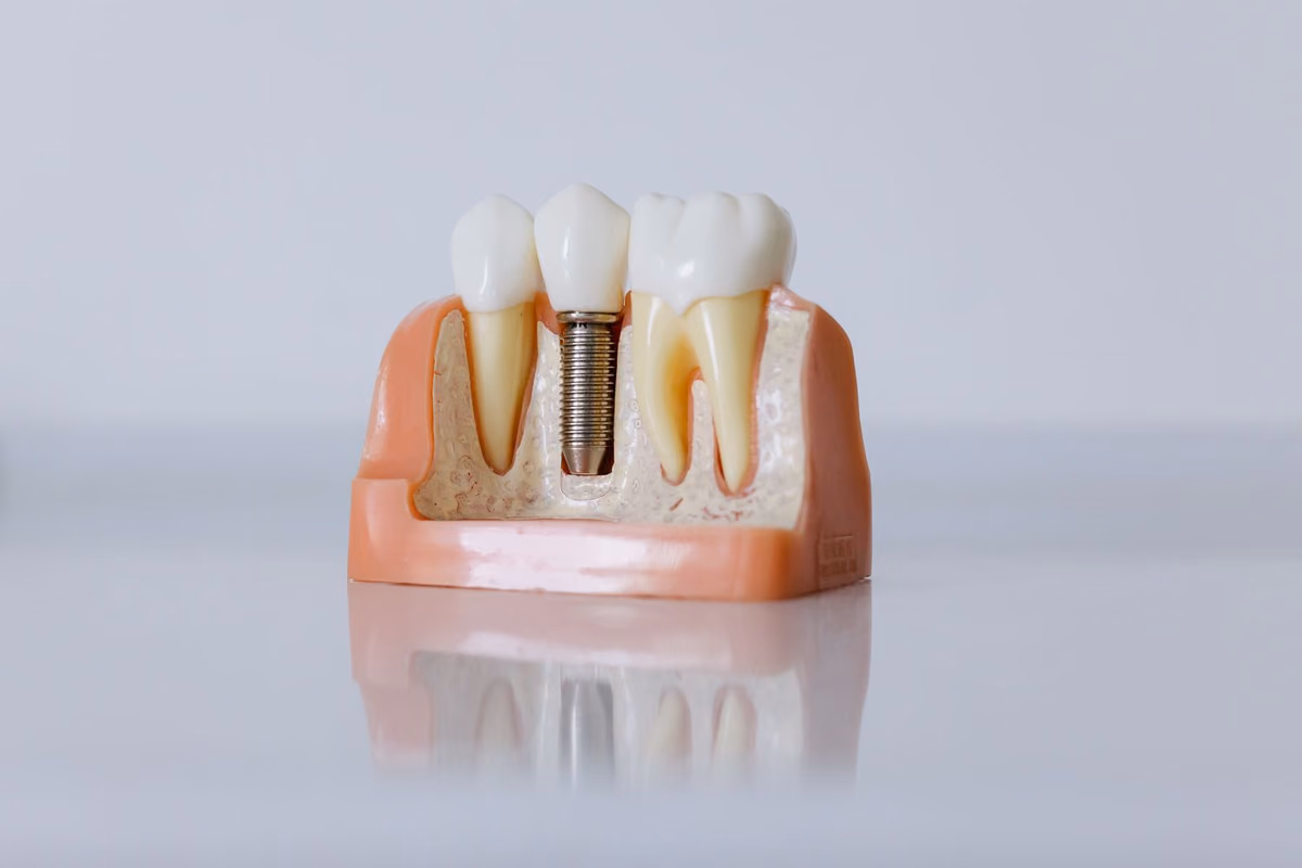 A cross-section dental model showing a titanium implant fixture in the jawbone with a crown on top, the components inside a single-tooth implant price.