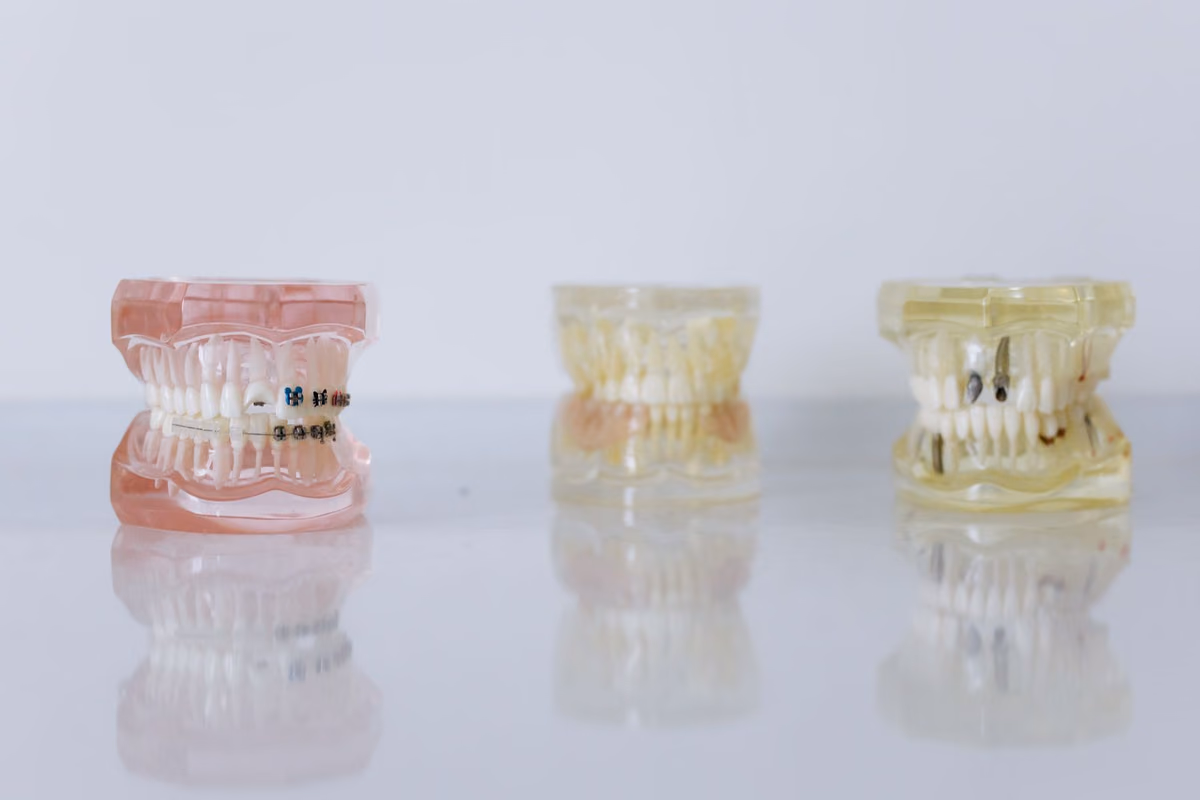 Dental study models fitted with different orthodontic appliances side by side, comparing how each type of invisible braces looks.