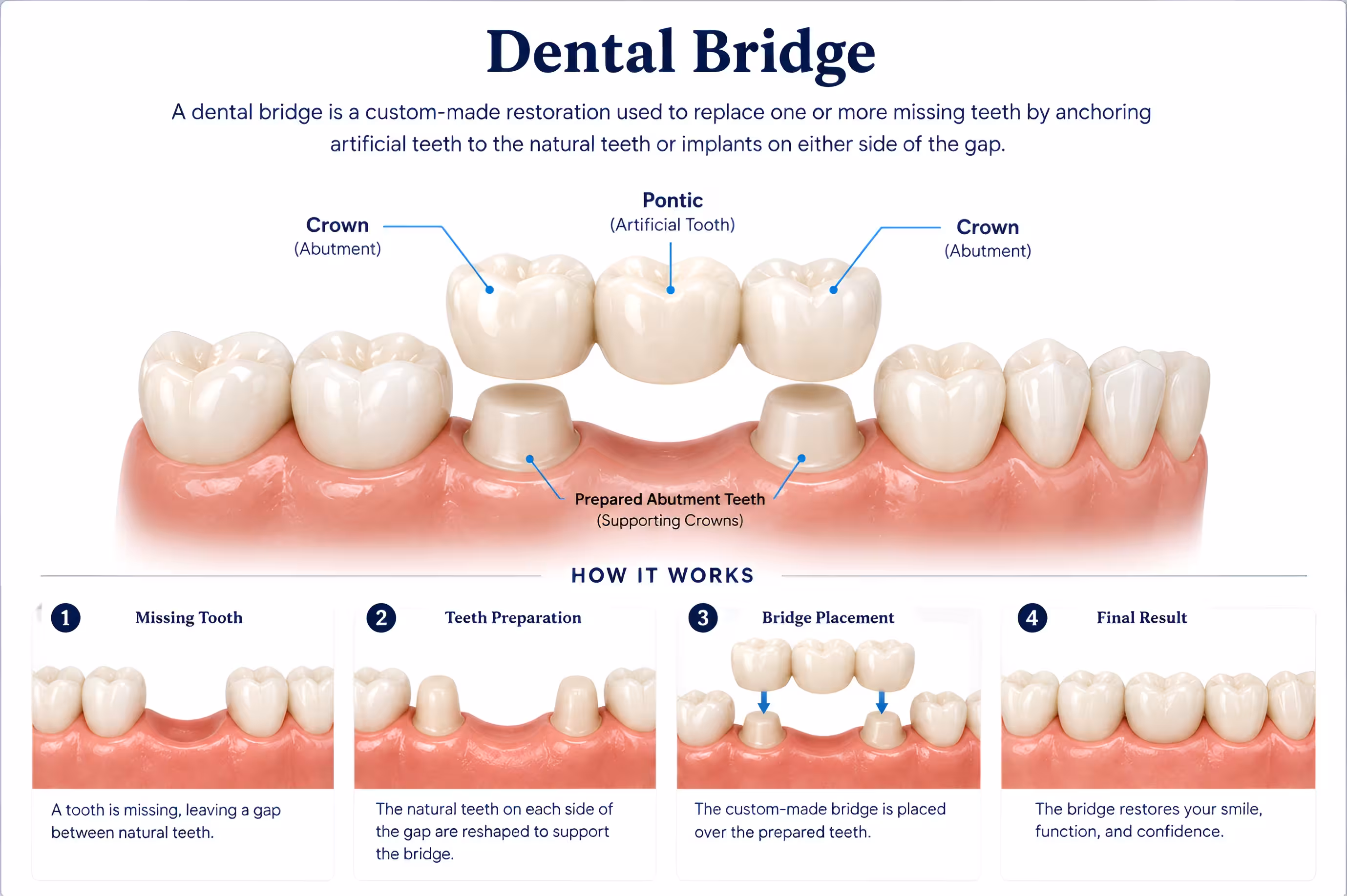 Comparison of Emax glass ceramic and zirconia dental crown materials on tooth models