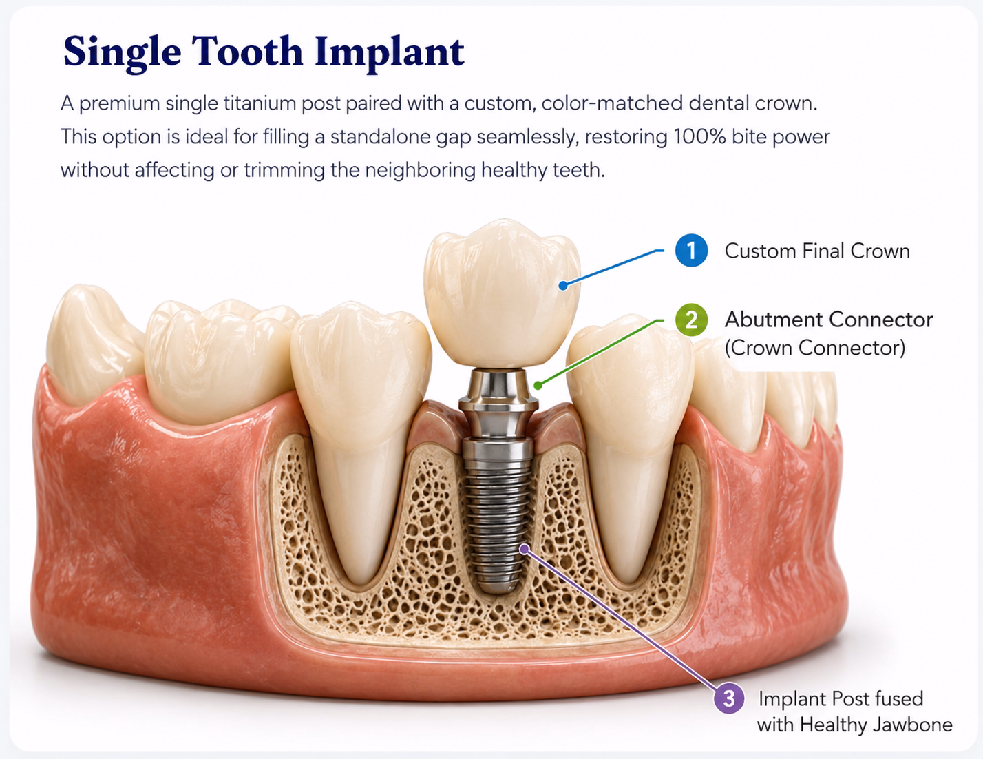 Single dental implant with custom crown replacing one missing tooth naturally