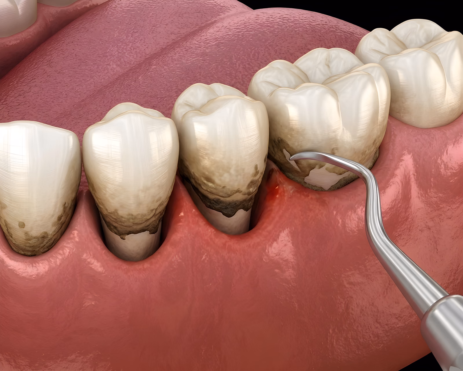 3D illustration of deep scaling and root planing removing tartar below the gumline for gum disease treatment.