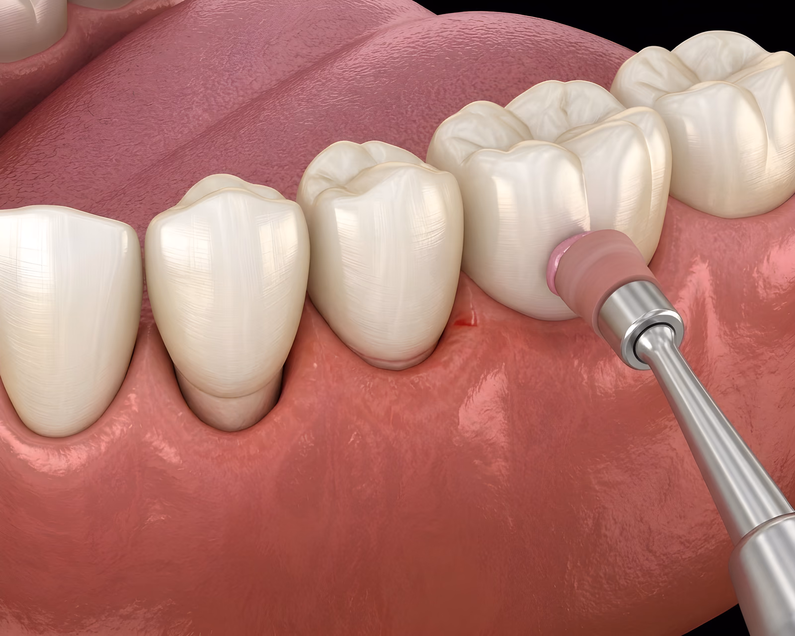 3D illustration of dental scaling and polishing treatment removing plaque from teeth at Lau Dental Clinic Sri Petaling.