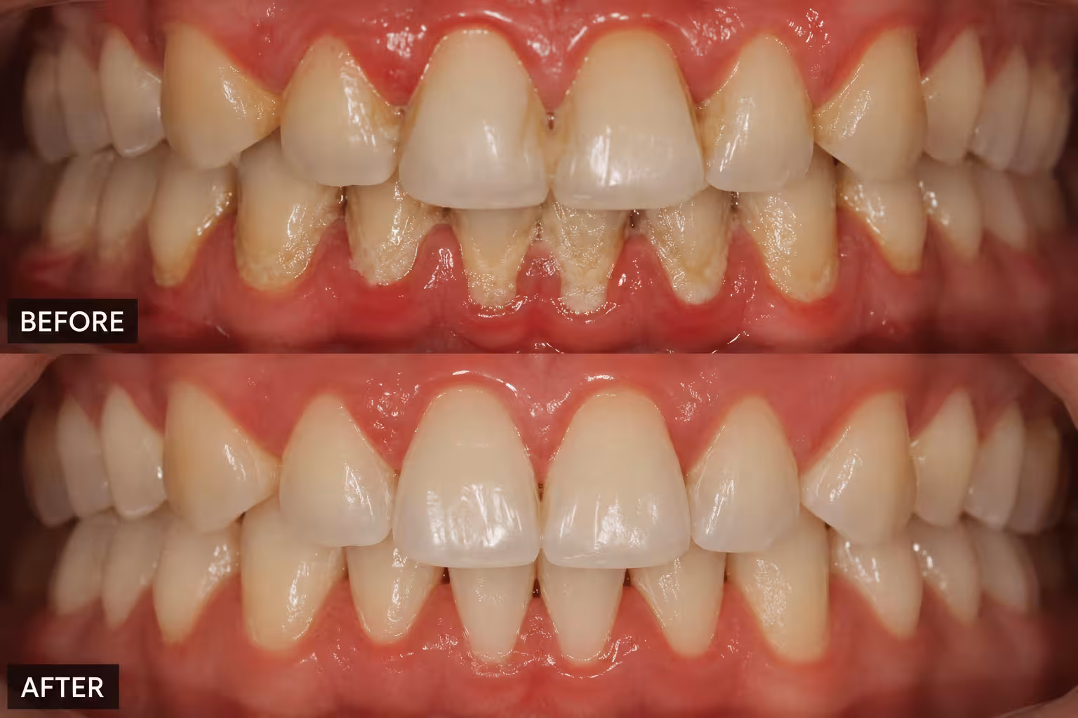 Deep scaling and root planing treatment for gum disease, removing tartar below the gumline to stop bleeding gums and improve oral health