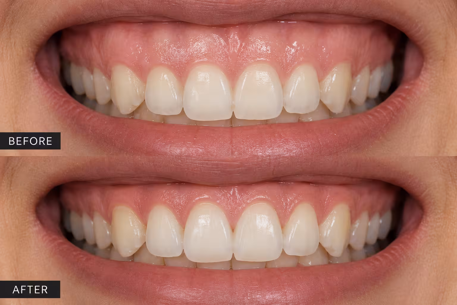 Aesthetic gum contouring and gingivectomy procedure to reshape excess gums and create a more balanced, attractive smile