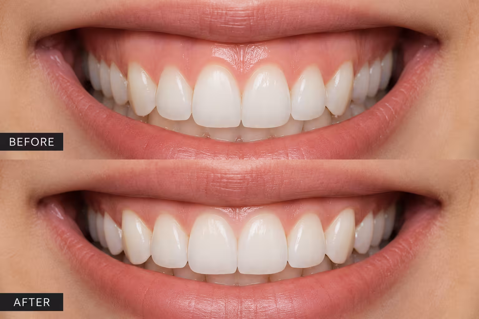 Gummy smile Botox treatment reducing excessive gum display and creating a more confident natural-looking smile