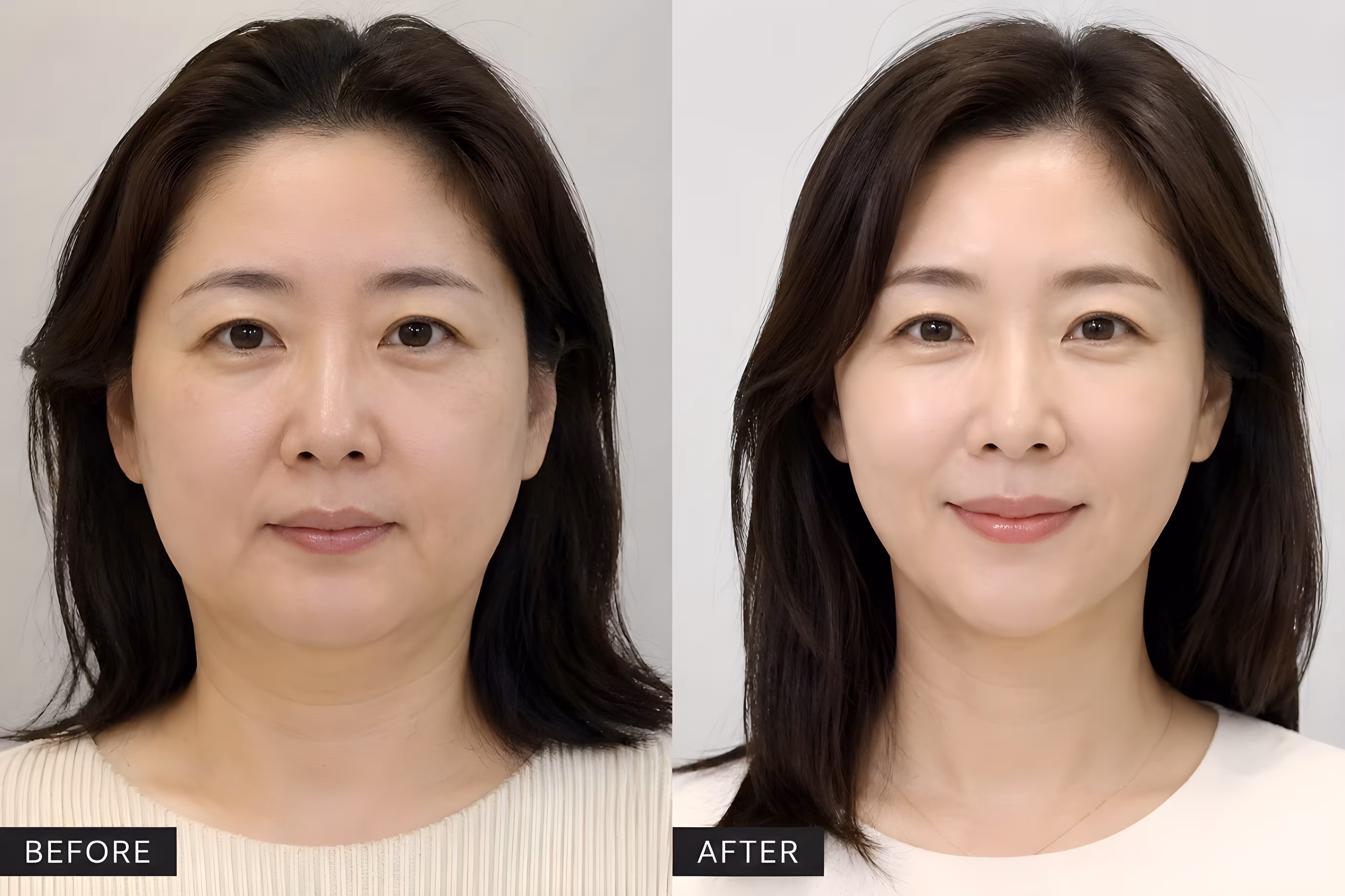 V-shape face slimming Botox treatment contouring the jawline, reducing masseter muscle size, and creating a slimmer facial profile