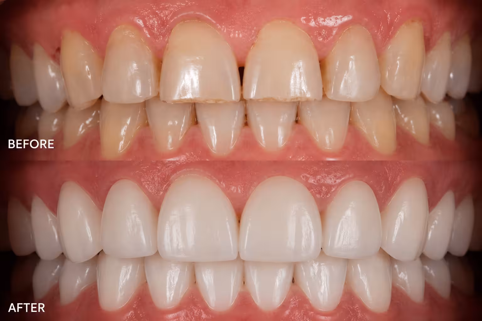 Close up of natural looking direct composite veneers improving front teeth appearance.