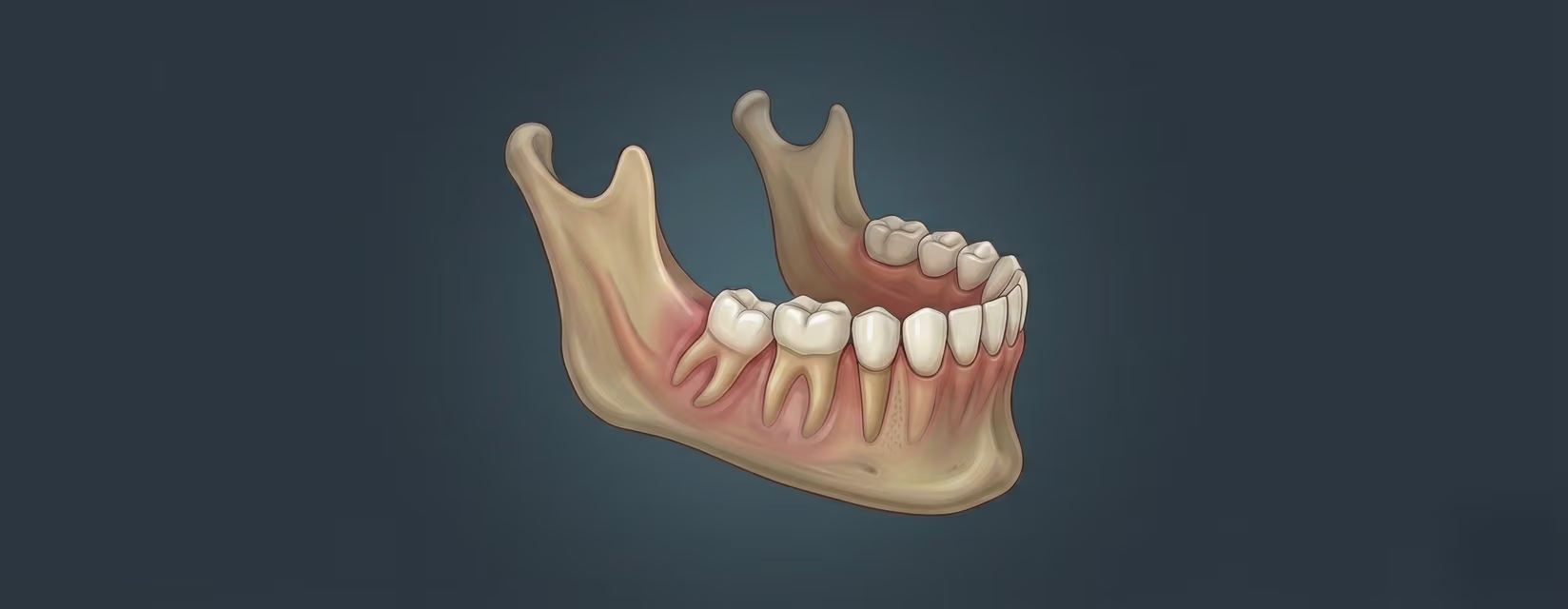 Illustration of impacted wisdom tooth and minor oral surgery extraction procedure