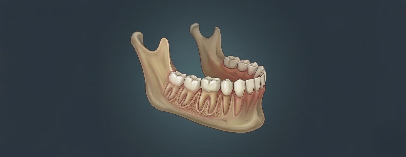 Illustration of non surgical wisdom tooth extraction from the lower jaw